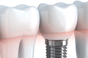 Columbus Dental Lab Implants