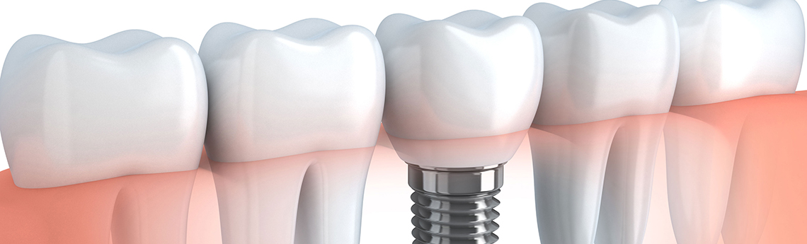 Columbus Dental Lab Implants